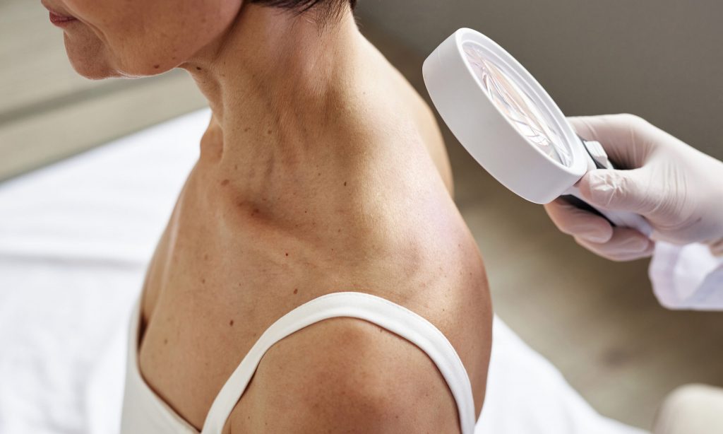 La Roche-Posay a effectué lundi des contrôles cutanés gratuits pour le mélanome