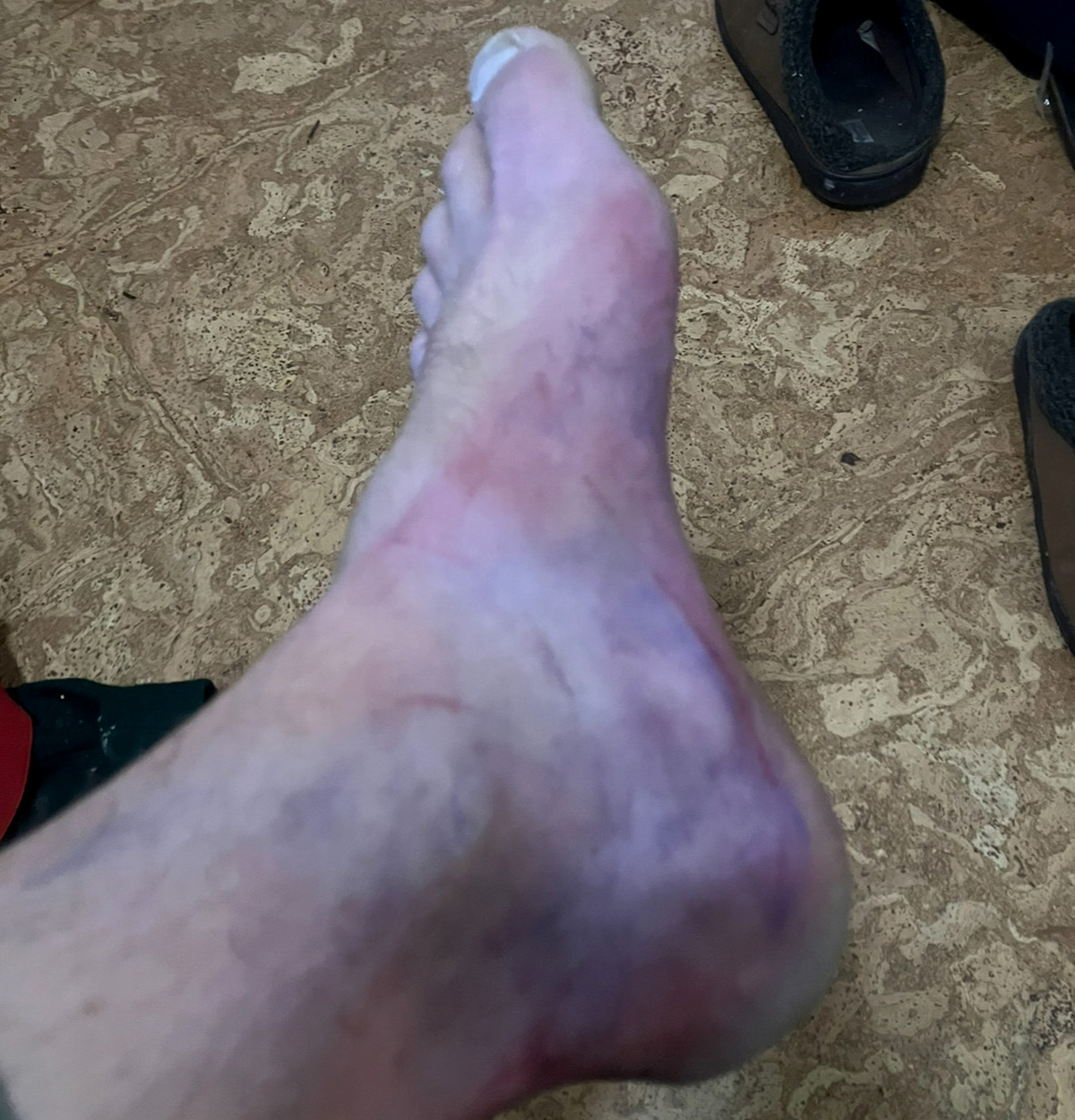 [Titre du site] J'ai détruit ma jambe en emballant mon cerf et j'aurais pu mourir