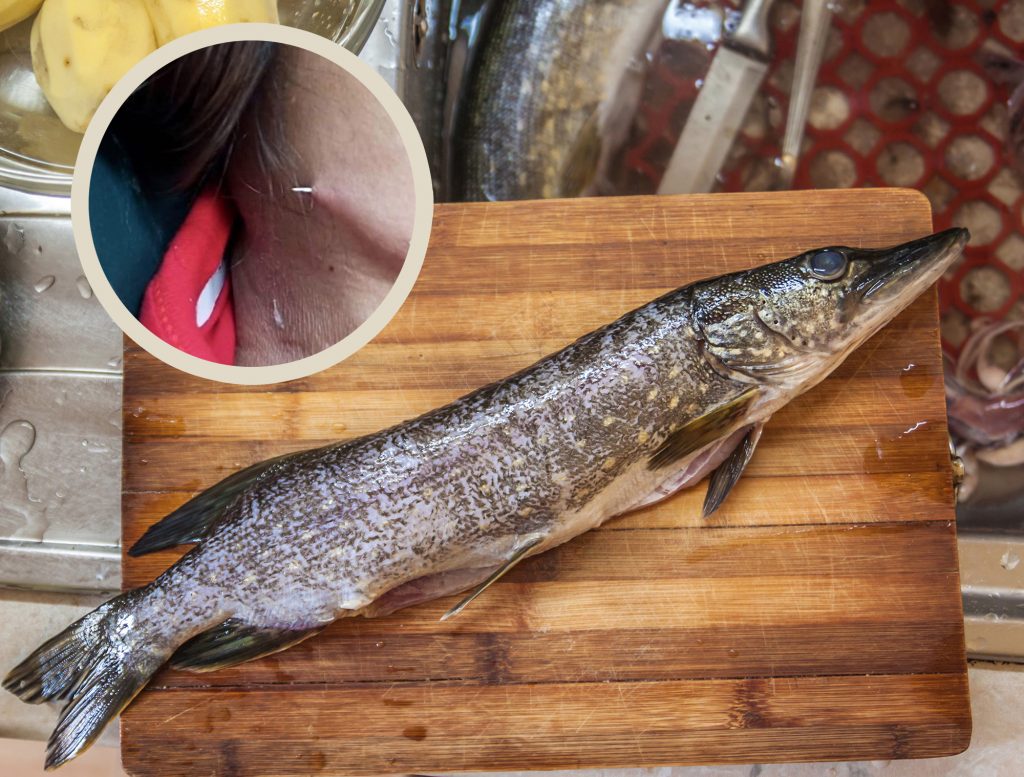 Fish Bone Perce le cou de la femme thaïlandaise - une histoire édifiante sur la consommation de poisson