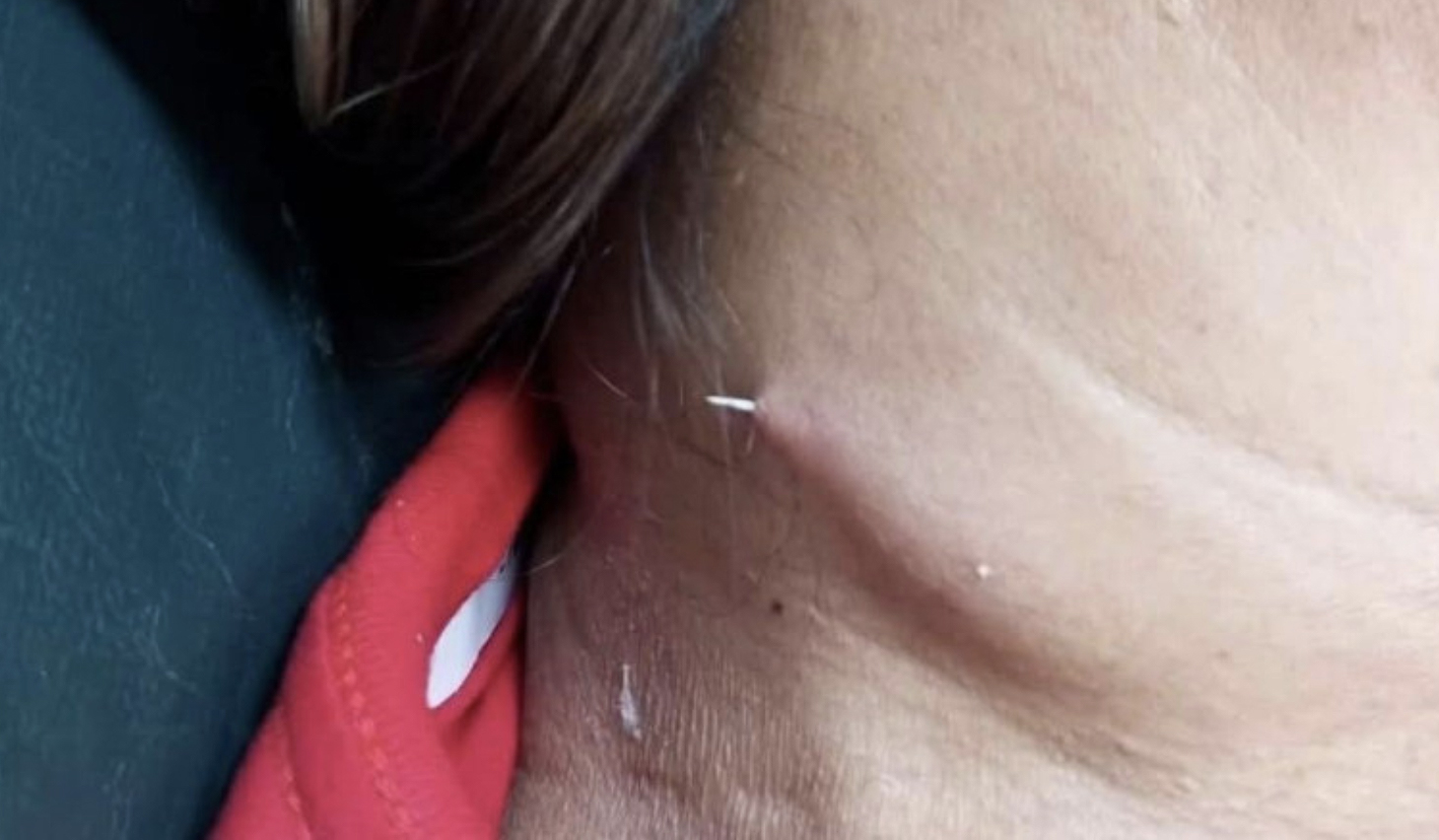 [Titre du site] Fish Bone Perce le cou de la femme thaïlandaise - une histoire édifiante sur la consommation de poisson