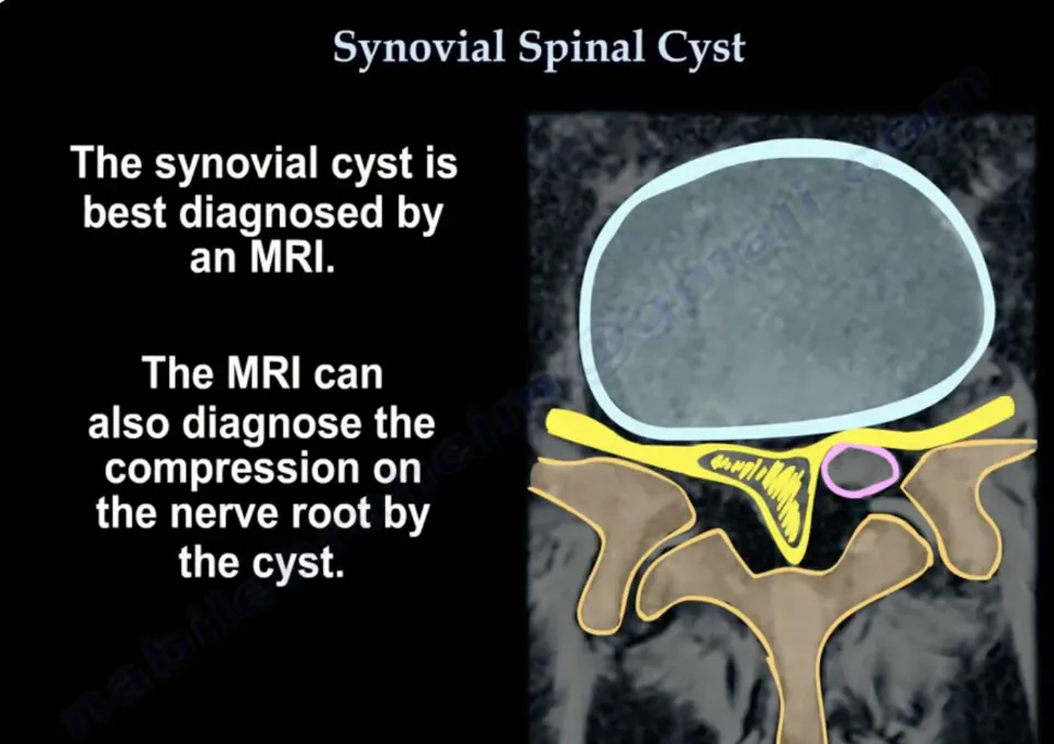 Kyste synovial