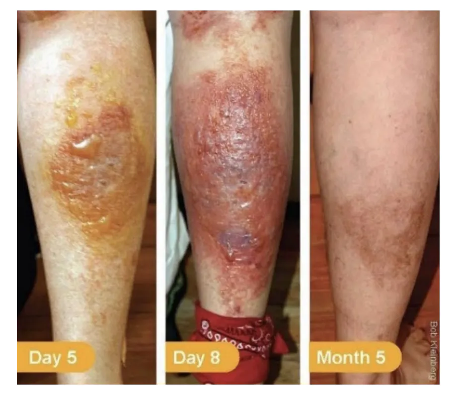 Veaux gravement brûlés par la berce du Caucase